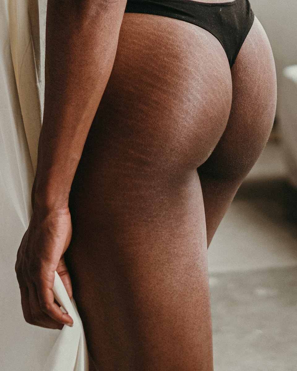 How To Get Rid Of Stretch Marks